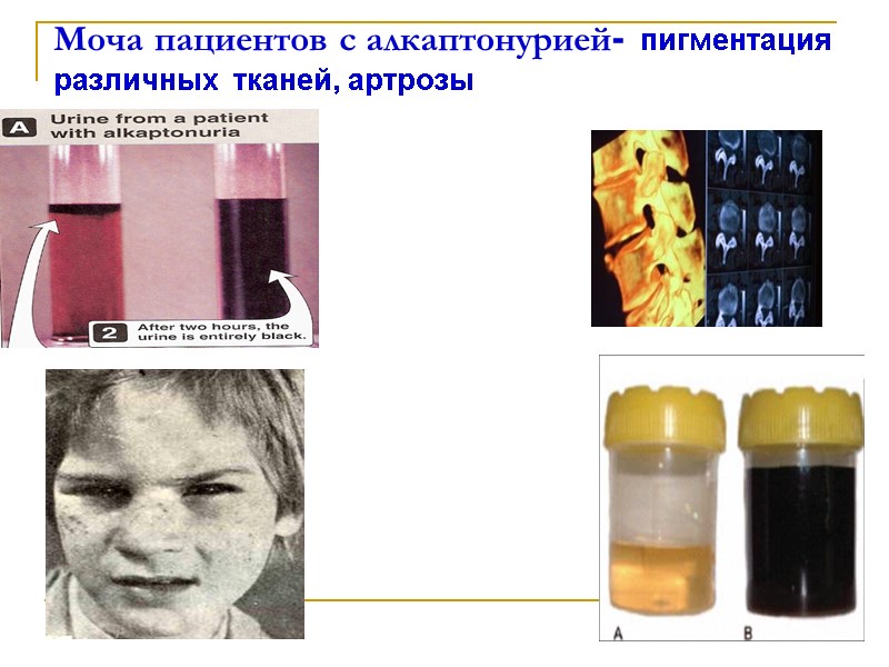 Моча пациентов с алкаптонурией- пигментация различных  тканей, артрозы